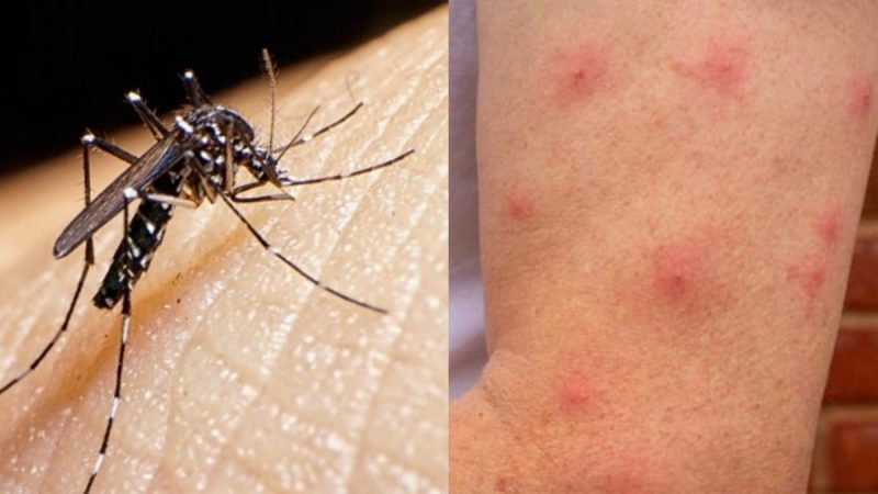 Γιατί τα κουνούπια τσιμπούν εσάς και όχι τους άλλους