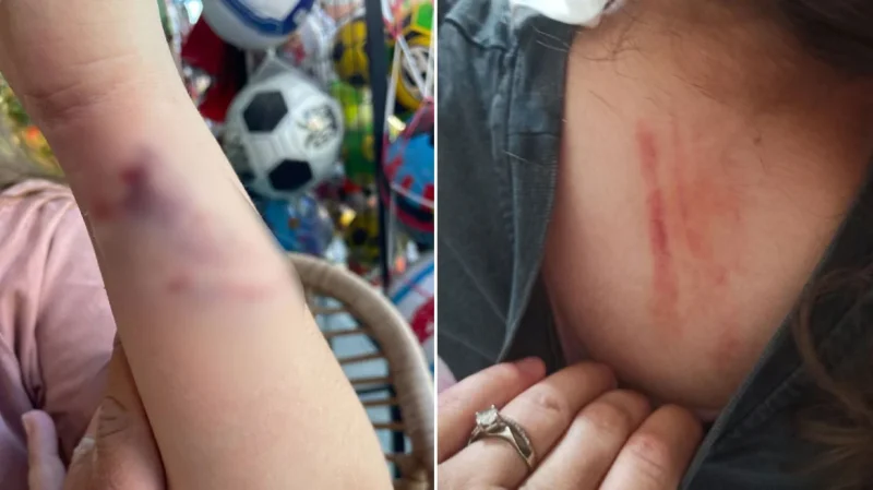 Πέλλα: Άγρια επίθεση από αδέσποτο σκύλο δέχτηκε μια 10χρονη - «Σώθηκε τελευταία στιγμή» λέει η μητέρα της